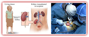 Kidney_transplant