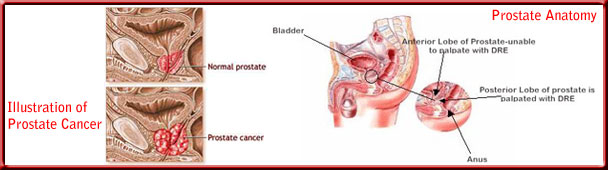 prostate_cancer_toppanel